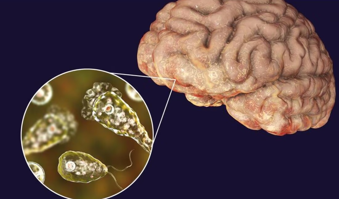 पानीमार्फत फैलिने अमीबाले केरलामा बढायो मृत्यु दर